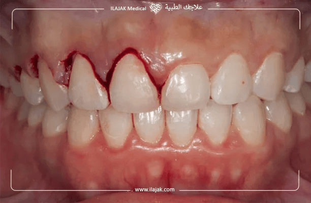 عملية التطويل التاجي أو تطويل الأسنان الأمامية بالحشوه