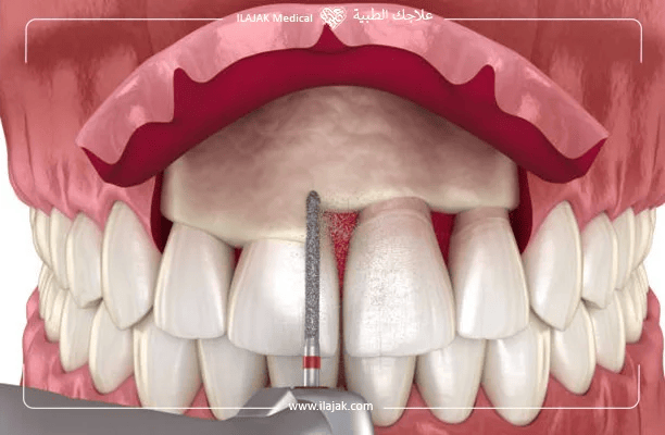 مميزات عملية التطويل التاجي