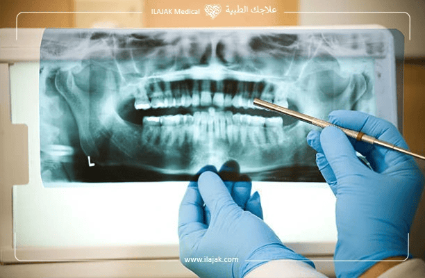 علاج قناة الجذر