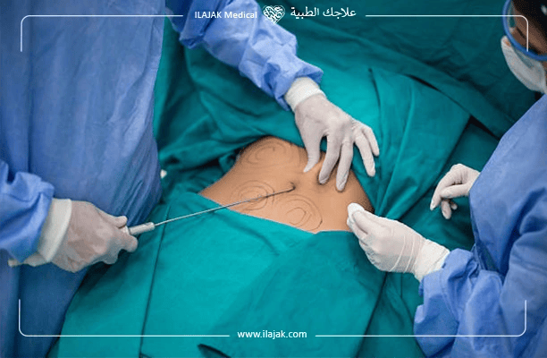 أفضل عيادات شفط الدهون في تركيا