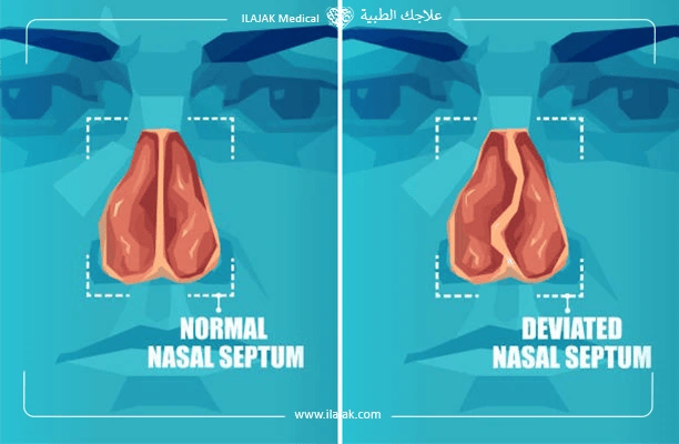What is a deviated septum