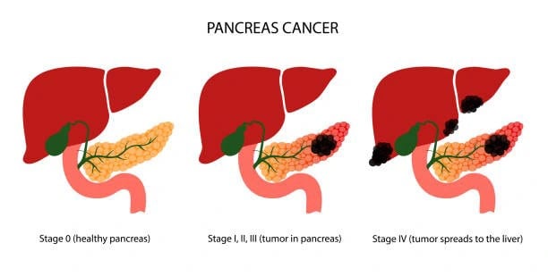 أنواع سرطان البنكرياس