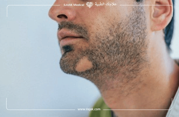 Beard 2025 hair loss