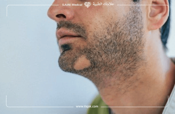 Beard Hair Loss Causes