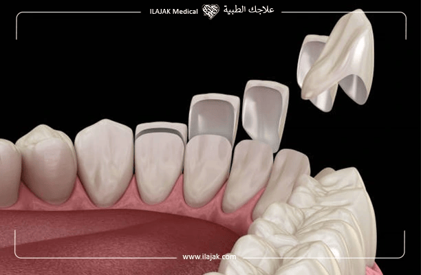 Procedures for Composite Bonding