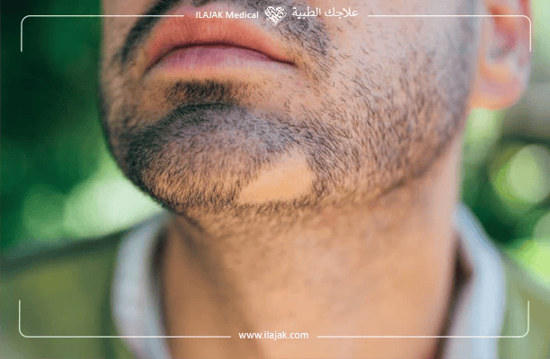 Side Effects of Beard Transplantation