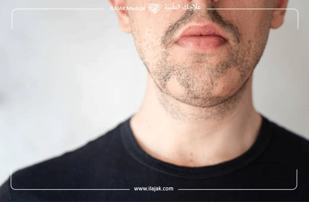 What to Expect After Beard Transplant