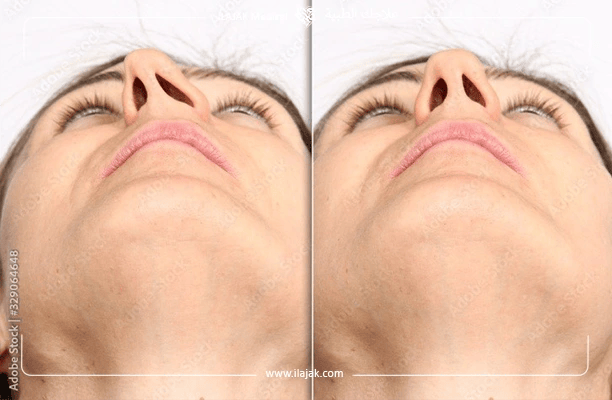 The difference between rhinoplasty and septoplasty