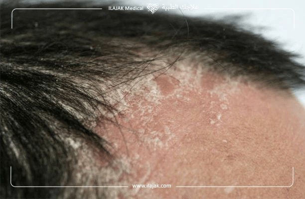 هل زراعة الشعر ممكنة لمرضى الصدفية