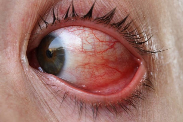  إلتهاب العين من الآثار الجانبية لعملية الليزك