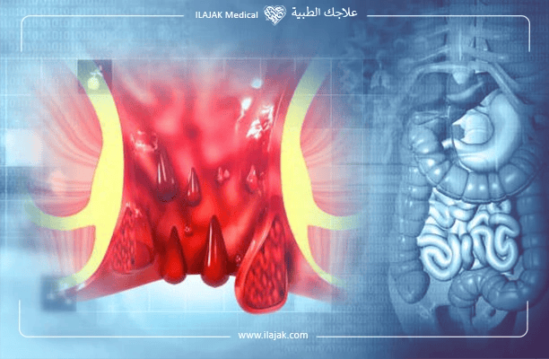البواسير والناسور قد تستدعي جراحة القولون والمستقيم