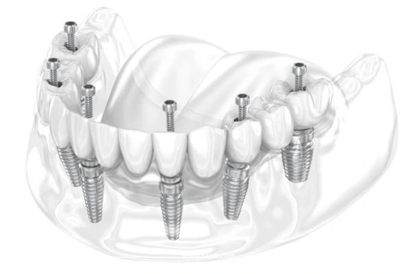 زراعة الأسنان الكل على ستة