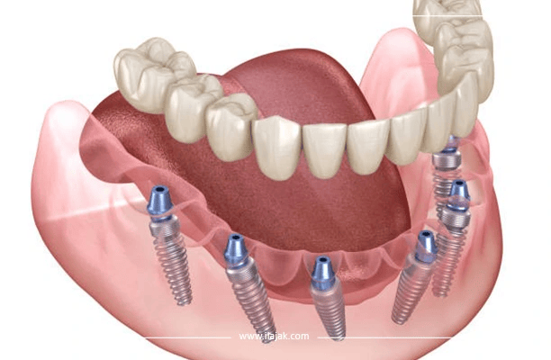 موانع زراعة الأسنان الكل على ستة