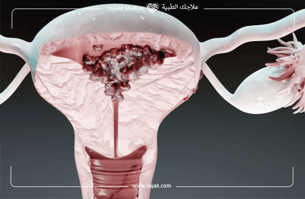 علاج سرطان الرحم