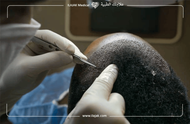 التعافي بعد زراعة الشعر