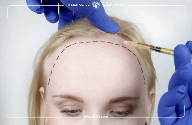 تقنيات زراعة شعر مقدمة الرأس للنساء