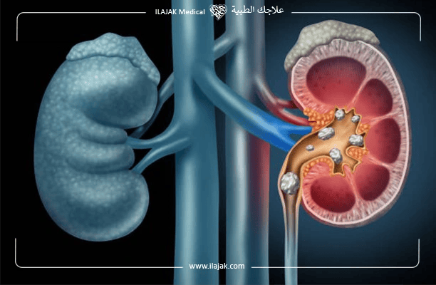 حصى الكلى