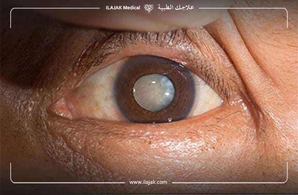 علاج المياه البيضاء في العين بدون جراحة
