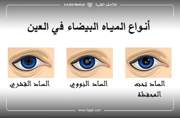 أنواع المياه البيضاء في العين