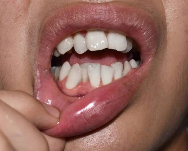 أعراض تزاحم الاسنان