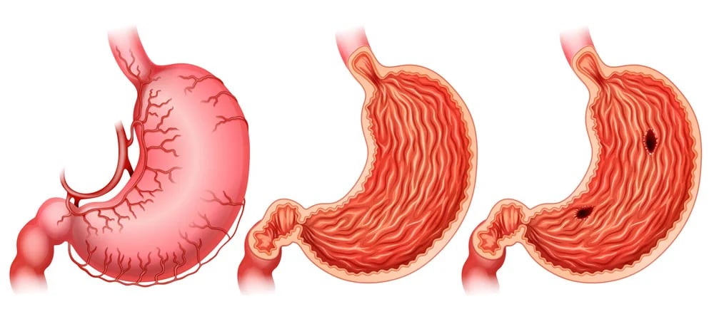 علاج قرحة المعدة