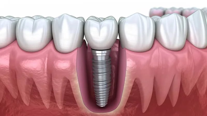أفضل أنواع زرعات الاسنان
