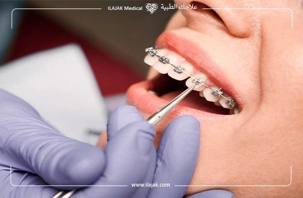التقويم المعدنى من افضل انواع تقويم الاسنان