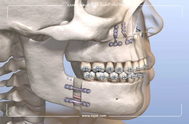 تقويم الأسنان الجراحي من اهم اشكال تقويم اسنان