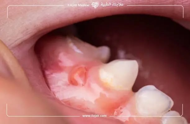 علاج التهاب عصب الاسنان