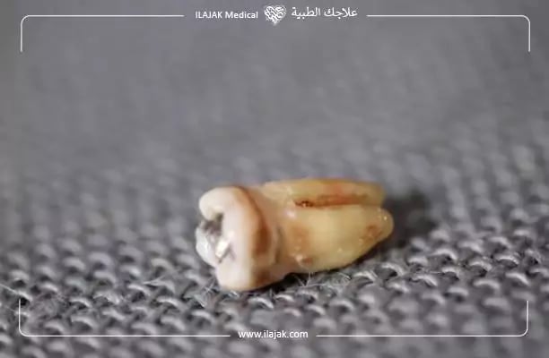 تسوس الجذر من أخطر أنواع تسوس الأسنان