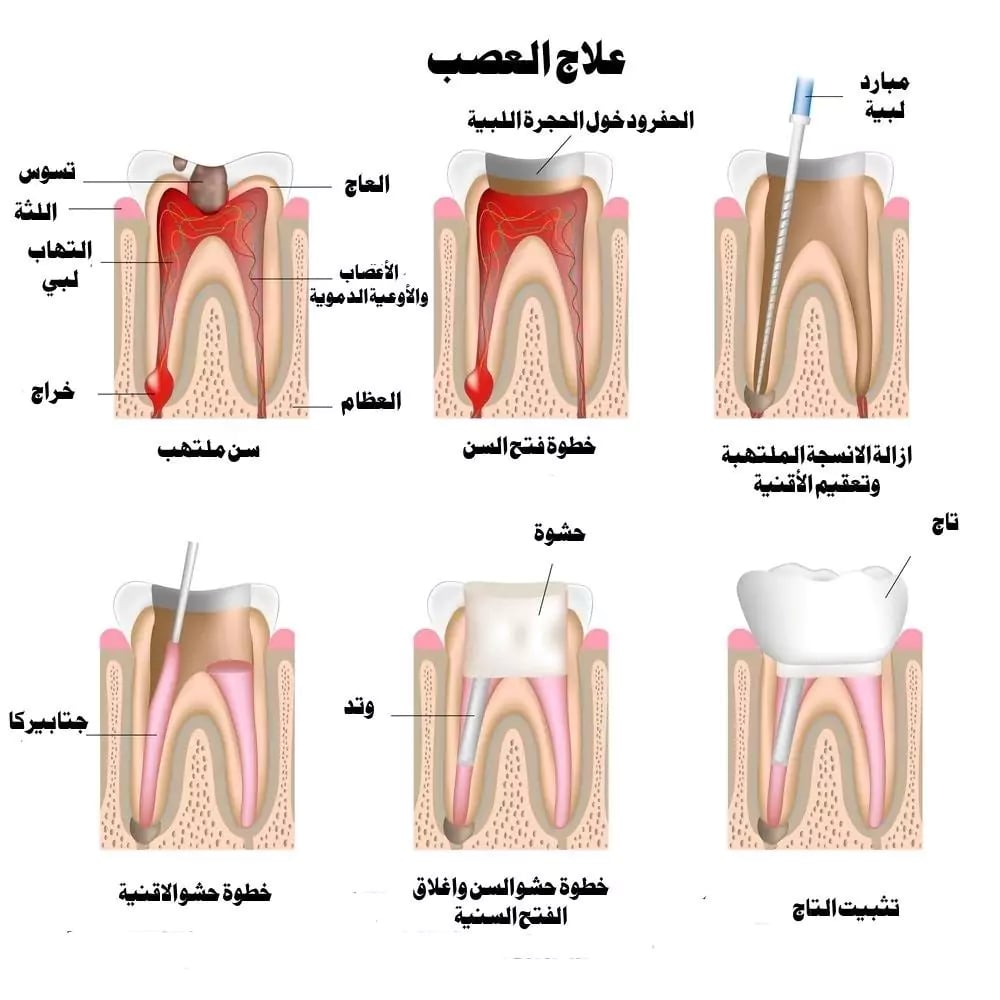 مراحل سحب العصب بالصور