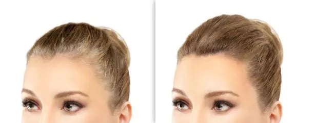 بعد العملية زراعة الشعر الايطالي