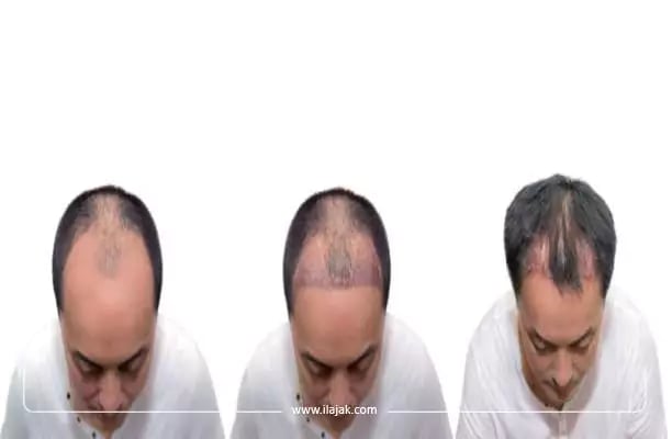مراحل نمو الشعر بعد الزراعة بالصور