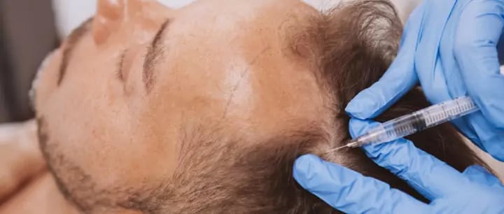 زراعة الشعر بدون حلاقة