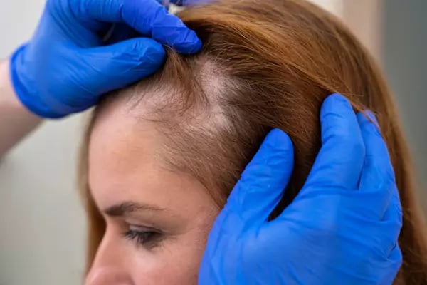زراعة الشعر للنساء بدون حلاقة