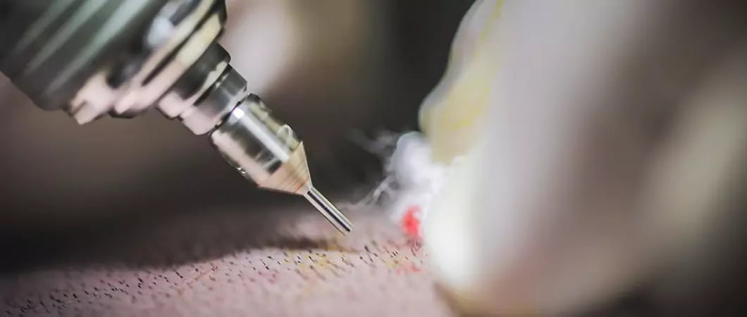 زراعة الشعر للسيدات وطرق زراعة الشعر للنساء بدون حلاقة