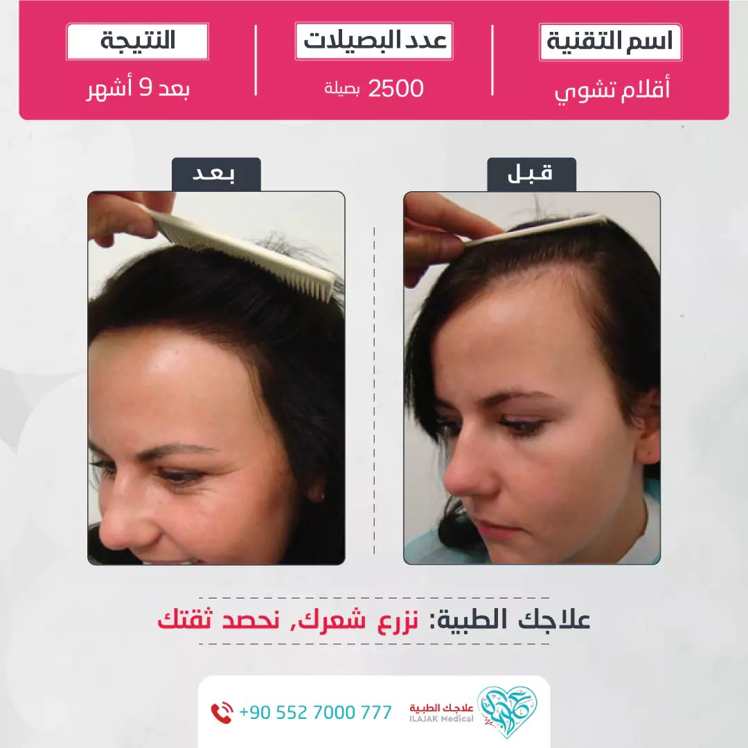 زراعة الشعر للنساء قبل وبعد