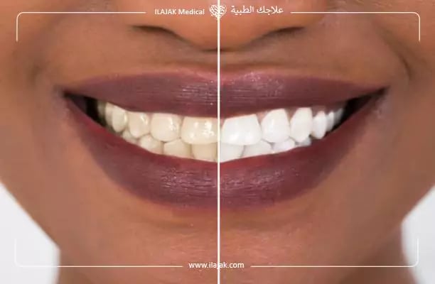 تكلفة ابتسامة هوليود في تركيا