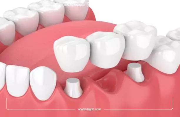 ثمن ابتسامة هوليود في تركيا - جسر الأسنان