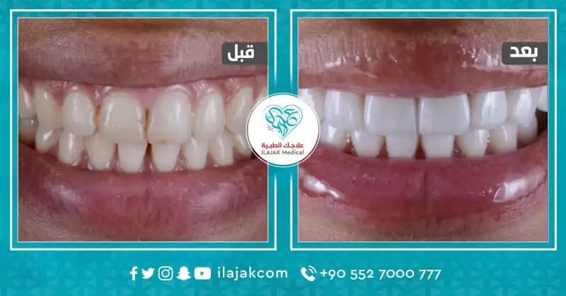 ابتسامة هوليود في تركيا قبل وبعد