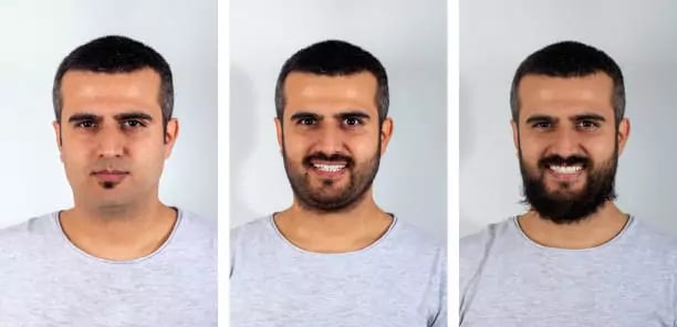 زراعة الشنب في تركيا قبل وبعد
