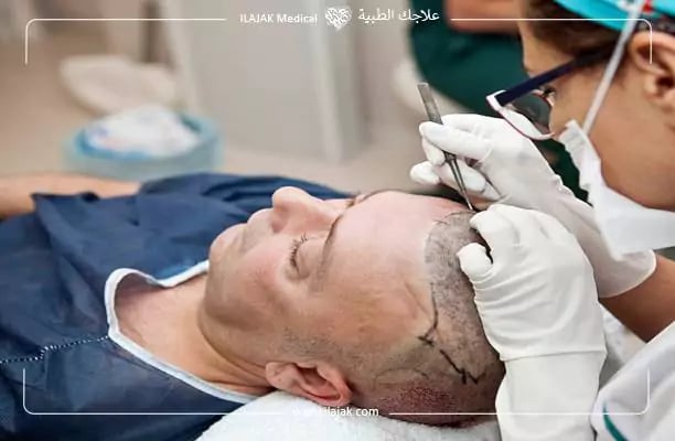 افضل مراكز زراعة الشعر في اسطنبول