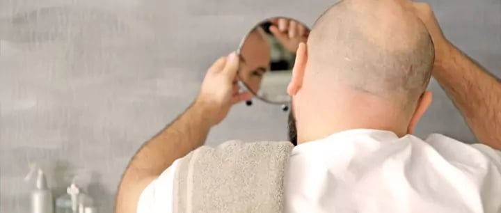 زراعة الشعر في تركيا للرجال
