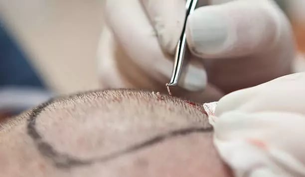 زراعه الشعر في تركيا بتقنية الاقتطاف FUE