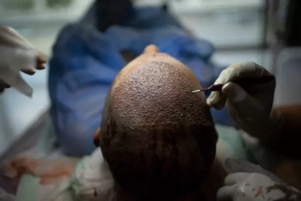 زراعة الشعر بتقنية السفير في مركز زراعة الشعر في تركيا الأشهر، مراكز علاجك الطبية