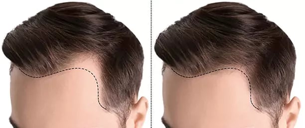 تكلفة زراعة الشعر في تركيا