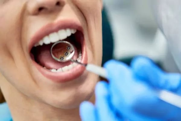 تركيب التقويم المخفي للأسنان أو التقويم الداخلي للأسنان