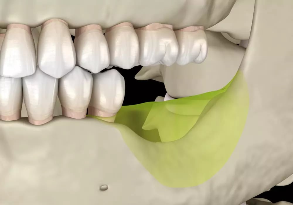 ضمور وتآكل عظام الأسنان