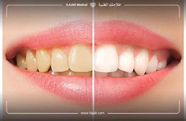 تجارب تبييض الأسنان بالزوم