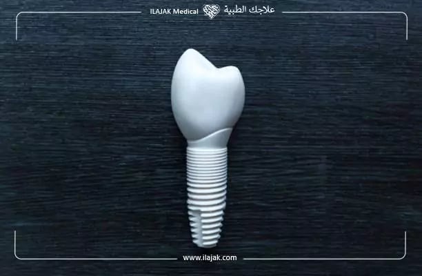 أنواع زراعة الأسنان وافضلها